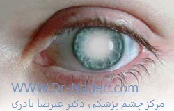 سوالات رایج درباره آب مروارید frequently asked questions about cataract